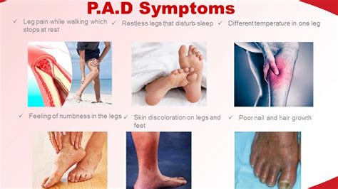 Facts About Peripheral Artery Disease (P.A.D) - YouTube