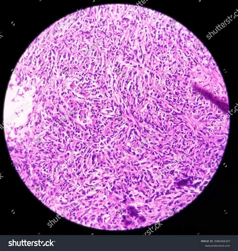 21 Trephine biopsy Images, Stock Photos & Vectors | Shutterstock