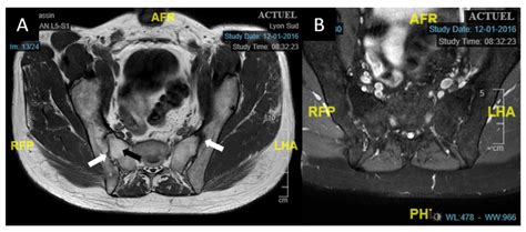 Axial sacroiliac MRI of case 1. (A): T1-weighted sacroiliac axial MRI ...