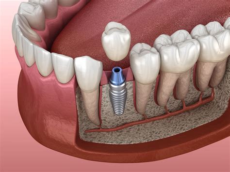 Single Tooth Implant - integratedDENTAL - Woodbury, NY