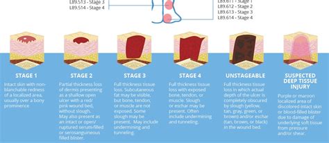 Skin Ulcer Stages