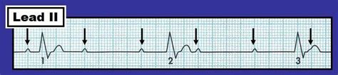 ECG Interpretation: ECG Interpretation Review #21 (Complete AV Block vs ...