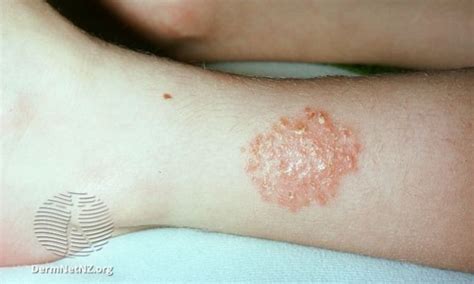 Discoid eczema | NHS inform