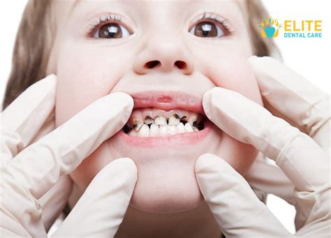 Black Teeth Causes and Treatment to Handle the Problem - Elite Dental Care