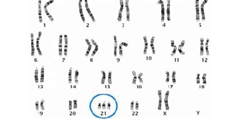 Trisomie 21 : désactiver le chromosome en trop - 19 juillet 2013 - Sciencesetavenir.fr