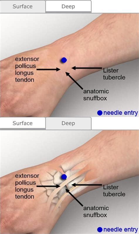 Arthrocentesis: Wrist - Procedures CONSULT JAPAN