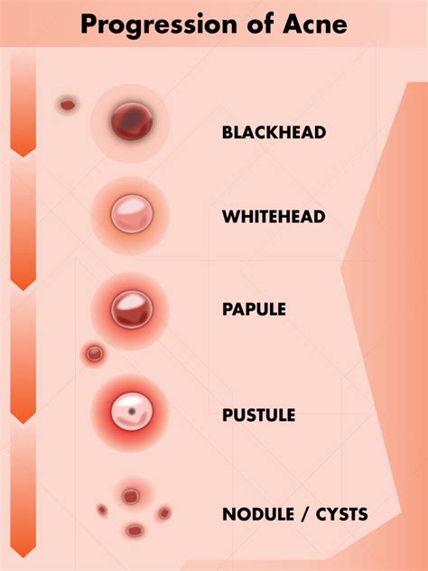 Pimple Herpes On Face Stages - krkfm