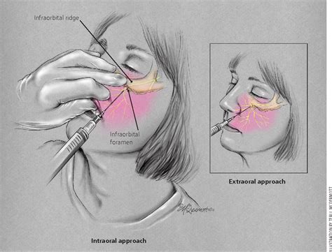 Figure 1 from Infiltrative anesthesia in office practice. | Semantic ...