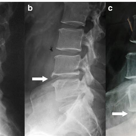 Assesment of the x-ray features of lumbar disc degeneration-lateral... | Download Scientific Diagram