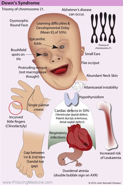 Pin on Syndrome +AMS