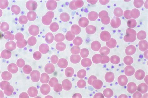 Essential Thrombocythemia, Peripheral Blood | This represent… | Flickr