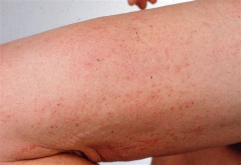 Dermatitis herpetiformis: Causes, treatment, and pictures