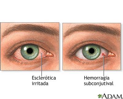 Ojos Rojos y Amarillos? porque la causa + remedio casero - Taringa!