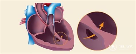 Repair of congenital heart defects in adults