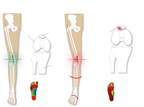 Overpronation "Epidemic"