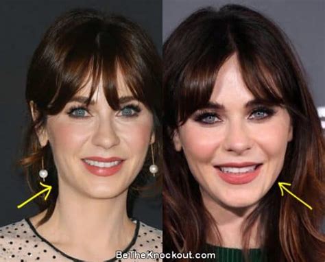 Zooey Deschanel Plastic Surgery Comparison Photos