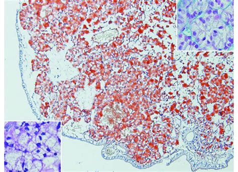 Special stains of the tumor cells. While fat stain (Sudan III) shows ...