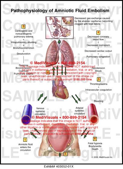 Medivisuals Pathophysiology of Amniotic Fluid Embolism Medical Illustration