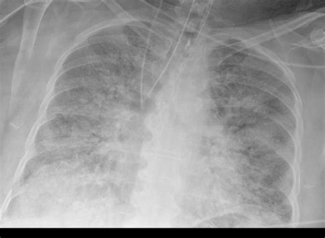 Ards Chest X Ray - lusomentepalavras