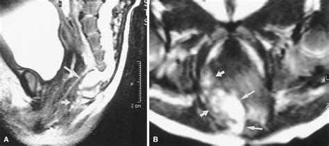 Figure 3 from High resolution MRI of anorectal malformation in the newborn: case reports of ...