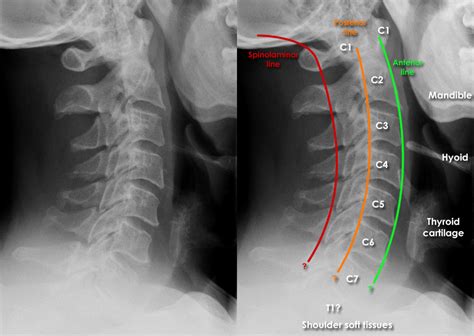 Trauma X-ray - Axial skeleton gallery 1 - Cervical spine - Image quality 1