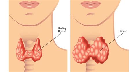 Symptoms and causes of hypothyroidism - Medrot.com