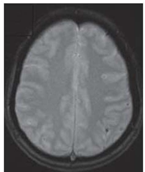 Cortical Laminar Necrosis as a Presenting Manifestation of Migraine in an Apparently Normal ...