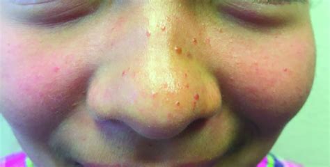 Red Bumps On Face