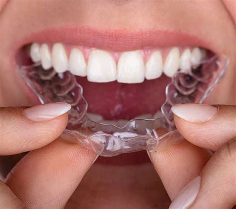 Invisalign Orthodontist | Rhinelander, WI | Bruce Orthodontics