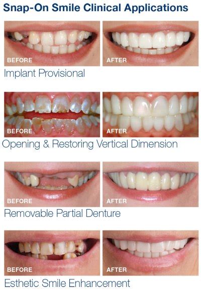 Snap-On Smile® - Mabel Dental Lab