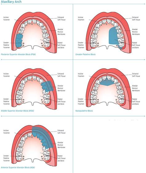 Maxillary Injection Sites | Dental hygiene school, Dentistry, Dental ...