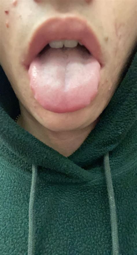 Tongue atrophy? : r/MuscleTwitch