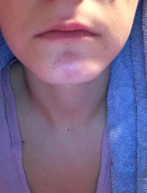 what is this hard red lump on my chin – Rosacea & facial redness – Acne.org Forum