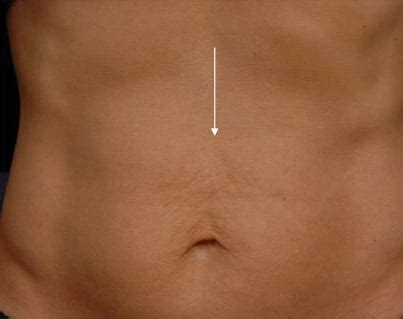 Abdominal Thermage Before and After Pictures | Santa Monica Laser and Skin Care Center