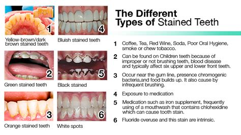 How To Remove Dark Yellow Stains From Teeth - TeethWalls