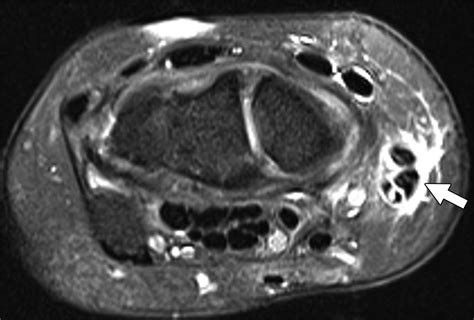 MRI of the Extensor Tendons of the Wrist | AJR