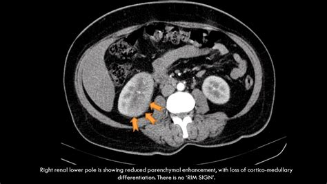 Ultimate Radiology : CASE OF BILATERAL PYELONEPHRITIS