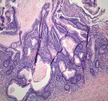 Pathological examination of case 1 shows a stage IA mucinous borderline... | Download Scientific ...