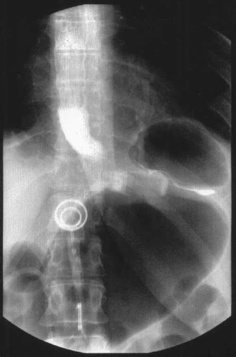 Complications of gastric banding presenting to the ED – AJEM