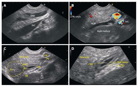 Common Hepatic Duct Ultrasound