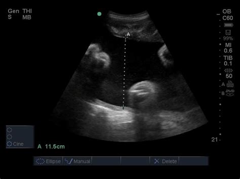 Normal amniotic fluid - pegulf