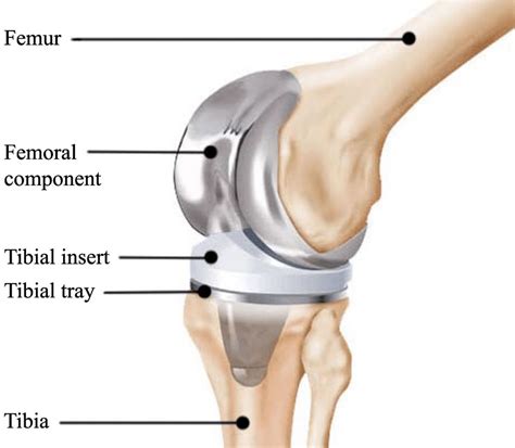 Knee Replacement Surgery Diagrams | Hot Sex Picture