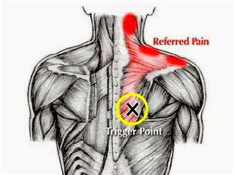 Body matters: DIY Acupressure | Shoulder blade | Rhomboid pain relief