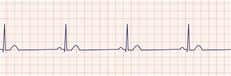 Bradycardia Definition, Causes, Symptoms & Treatment - Phlebotomy Career Training