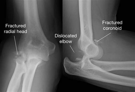 Why Is It That Surgeons Call Certain Elbow Injuries “Terrible Triad”? - Shoulder & Elbow