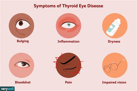 Pin by Brookejenn on {Eye Notes} | Thyroid symptoms, Disease symptoms ...