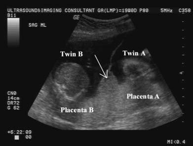 DMS333WI2021: Amnio and Chorio's