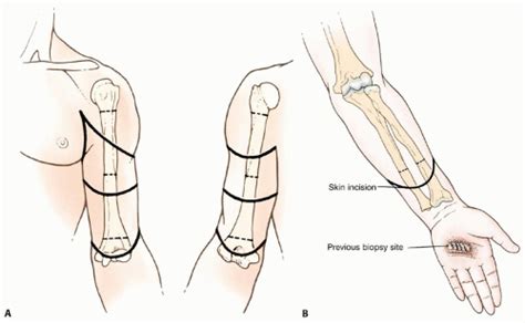 Above-Elbow and Below-Elbow Amputations | Musculoskeletal Key