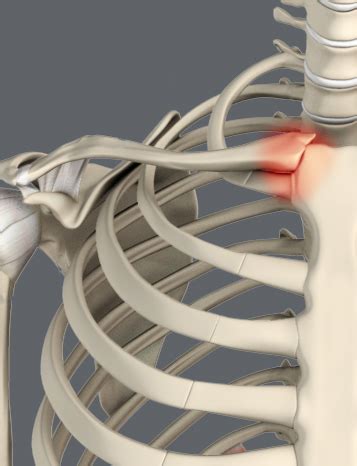 Sternoclavicular Joint Disorders Salem, OR | Joint Dislocations Eugene, OR