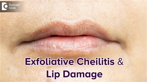 Exfoliative Cheilitis Lips Treatment | Lipstutorial.org